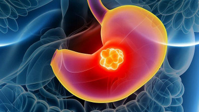 A gyomor-és gyomor-nyelőcső átmenet (GEJ) rák molekuláris diagnosztikája